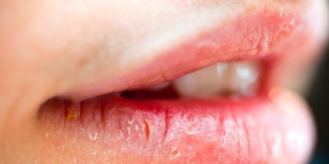 agiz-ve-dudaktaki-yaralari-hafife-almayin-onemli-hastaliklarin-belirtisi-olabilir-eK3xWjdV.jpg